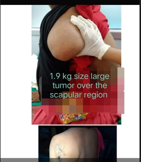 Dr. Kiran Prabhakar Rebello — Pioneering Surgical Feat: Largest Lipoma 1.9  Kilogram Successfully Removed